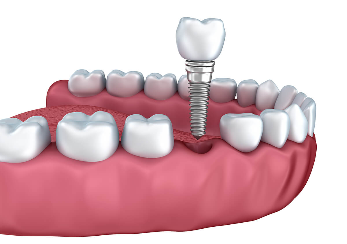 Dental Implants Surgery in Bardstown KY Area