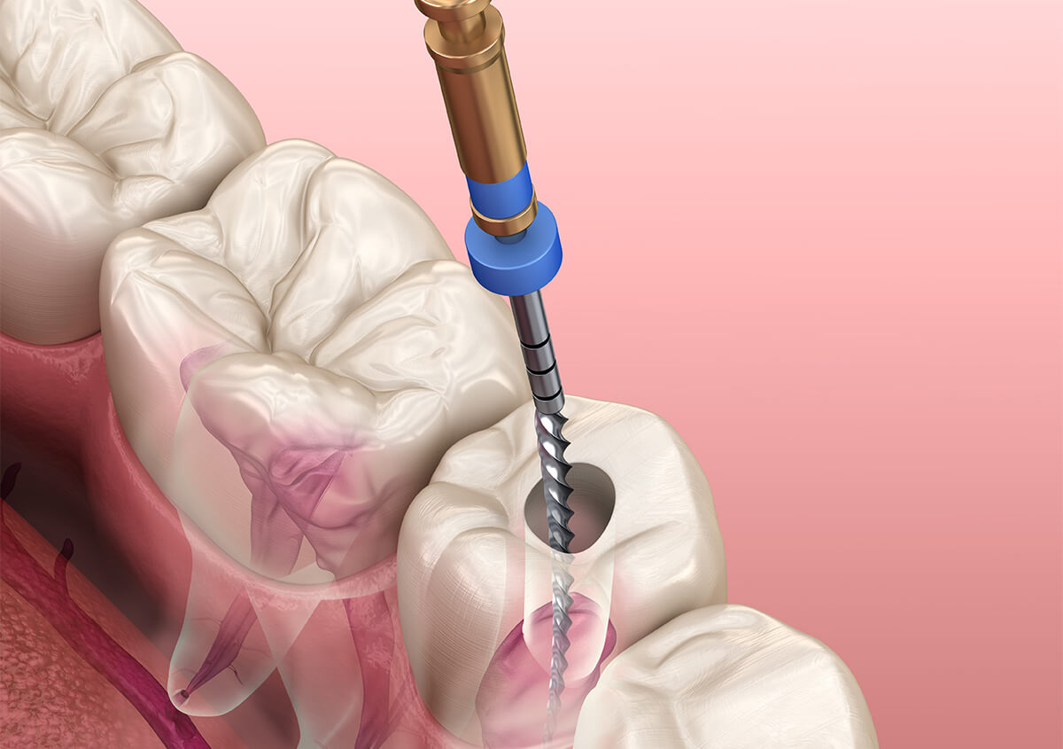 Endodontic Treatment in Bardstown KY Area