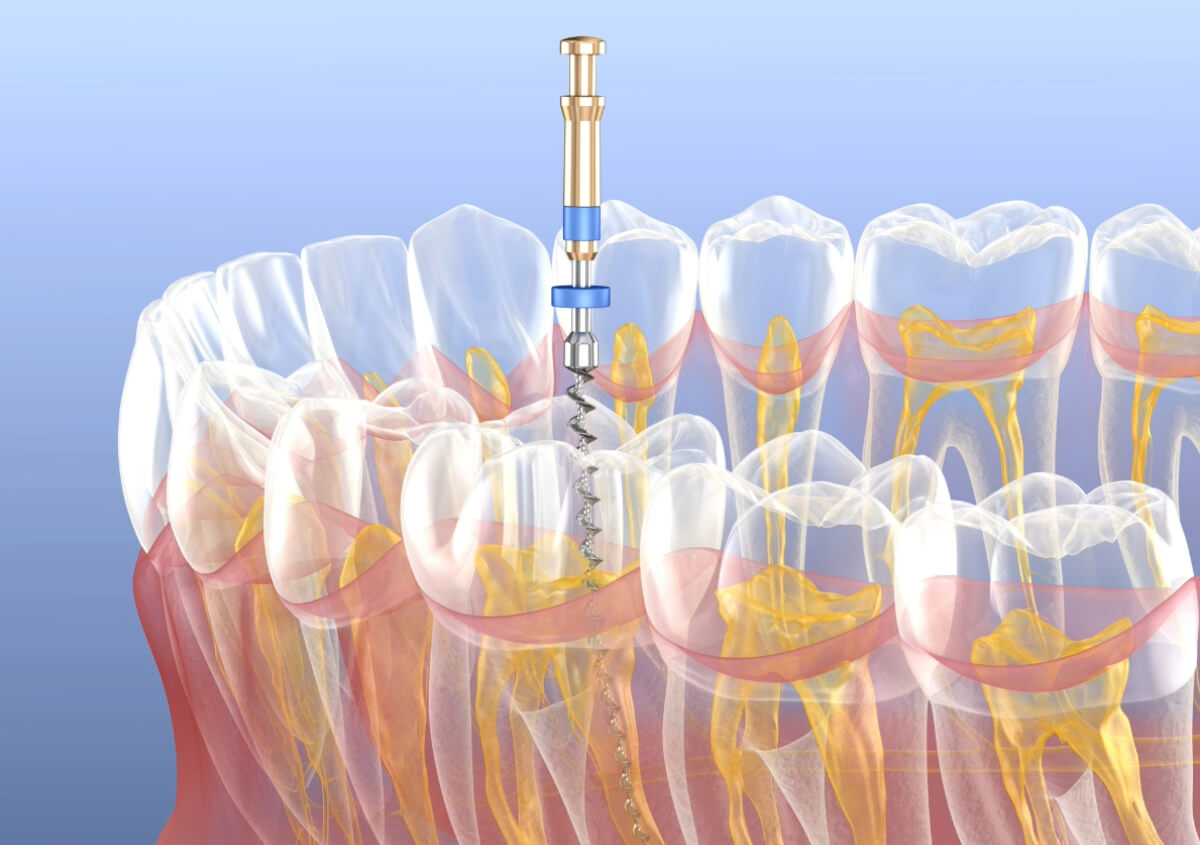 Root Canal in Bardstown KY area