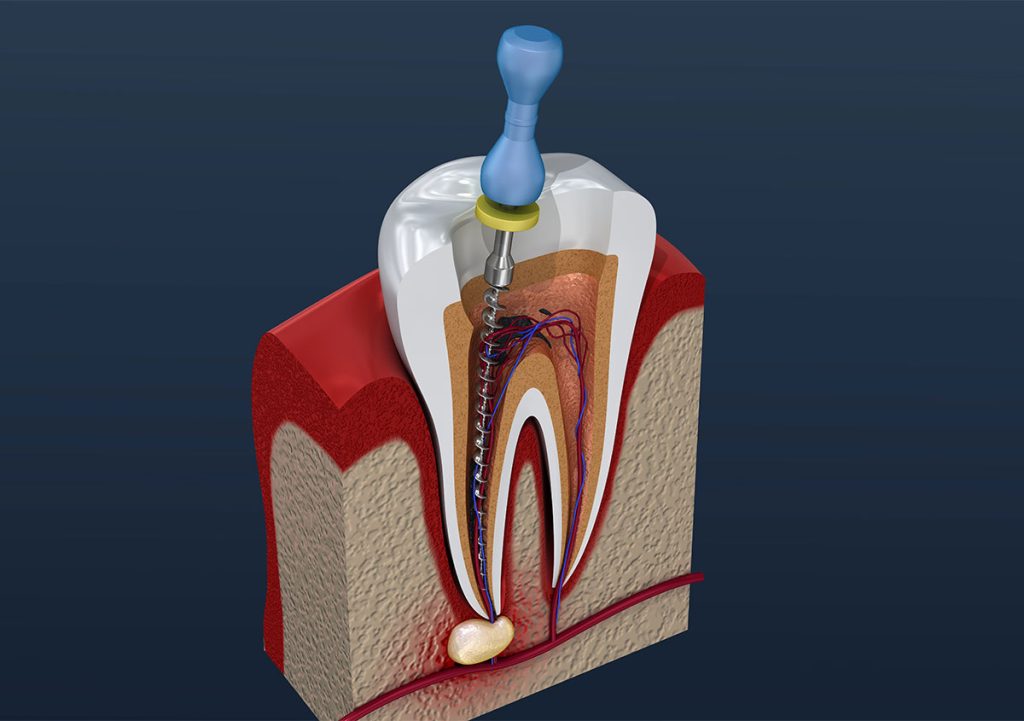 Save Your Natural Tooth with Root Canal Treatment in Kentucky Dr. Michael Walton, DMD Walton Family Dentistry